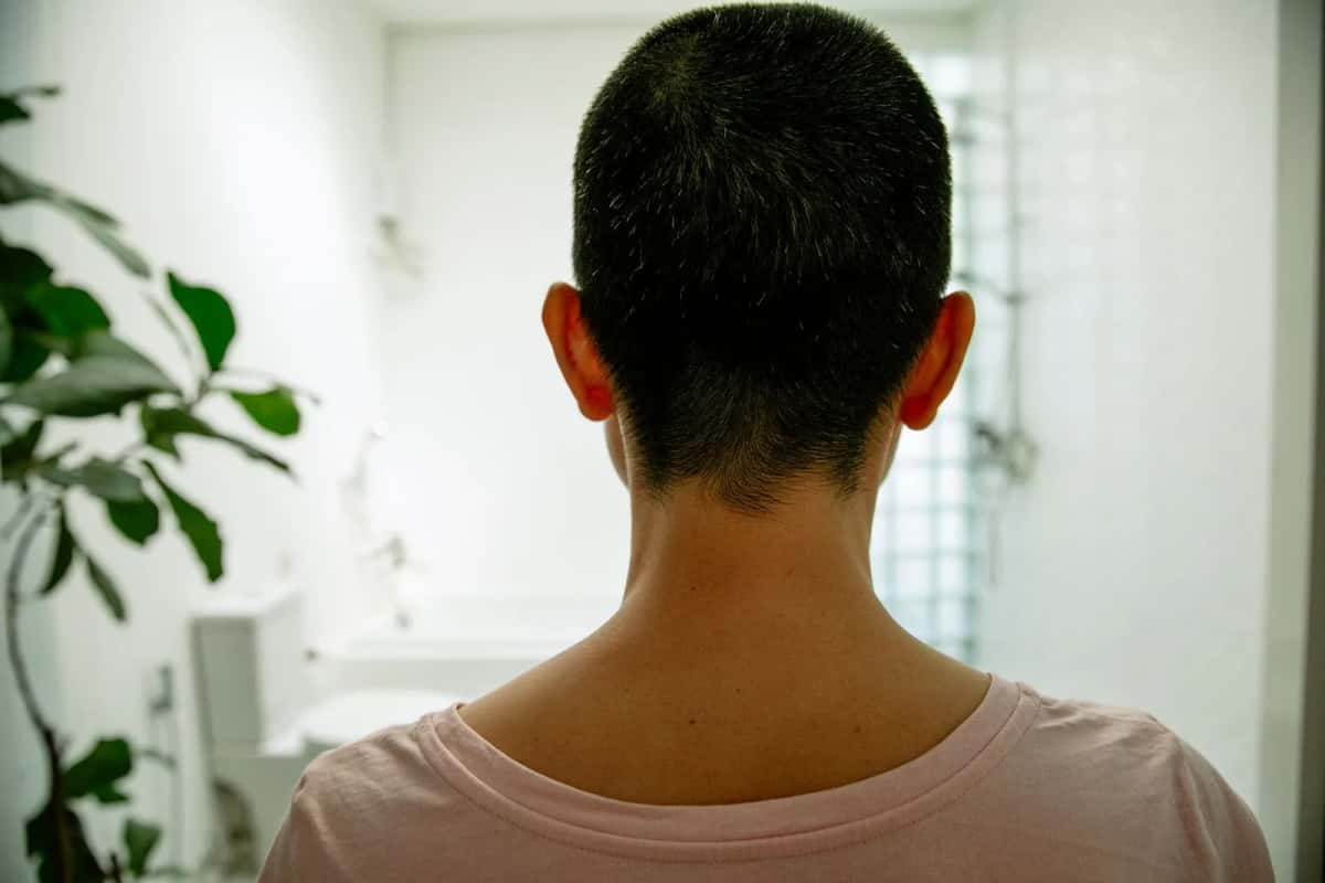Arrière du crâne d'un homme aux cheveux courts, la zone donneuse d'une greffe